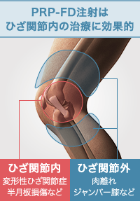 PRP-FD（PFC-FD）注射はひざ関節内の治療に効果的