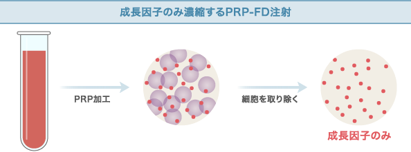 成長因子のみ濃縮するPRP-FD（PFC-FD）注射